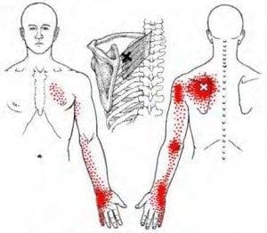Common pain referral pattern from the levator scapula/upper trapezius region