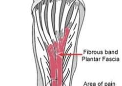 plantar-fasciitis-2