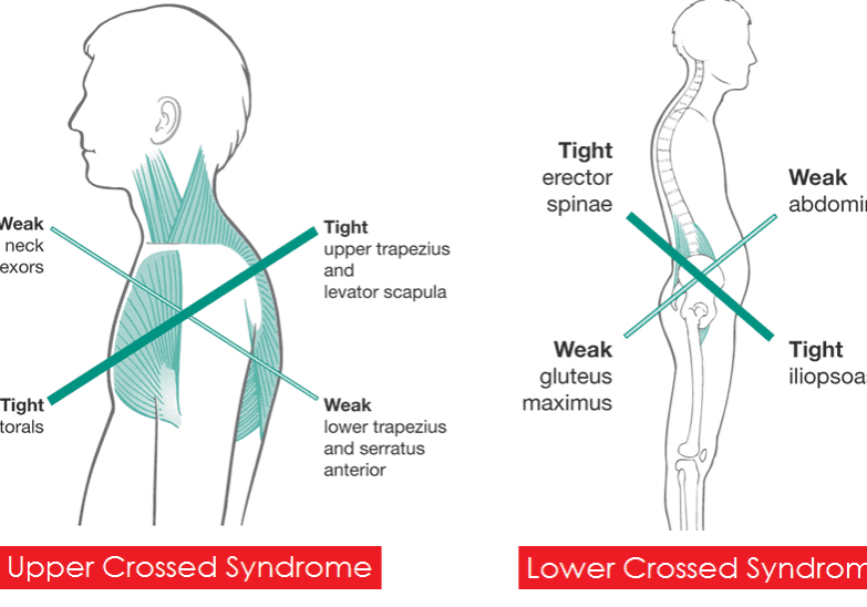 upper-and-lower-crossed-syndrome1